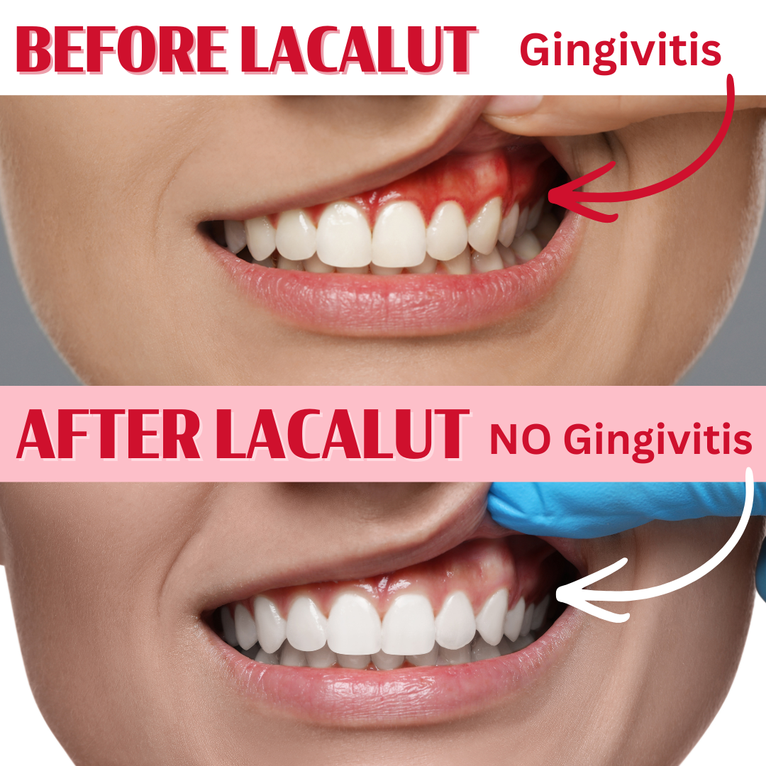 Travel Size Gingivitis Mouthwash For Gum Disease | Astrigent Effect Stops Bleeding Gums Fast | LACALUT® AKTIV Mouthwash 50ml Bottle